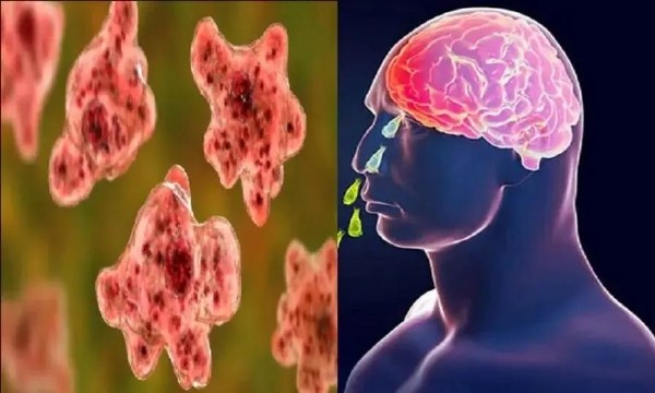Amebic Meningoencephalitis Amebic Meningoencephalitis