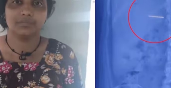 സിനിമാ സ്റ്റൈൽ മോഷണം: പിടിയിലായപ്പോൾ സ്വർണ്ണമാല വിഴുങ്ങി യുവതി; കോഴിക്കോട് മെഡിക്കൽ കോളേജിൽ നാടകീയ രംഗങ്ങൾ