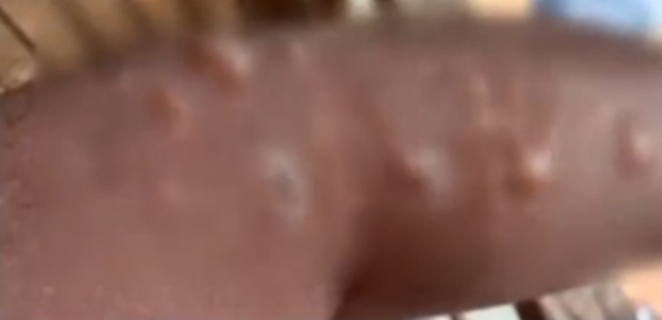 താനൂരിൽ കടുത്ത ചൂട്: യുവാവിന് സൂര്യാതപമേറ്റു; ജാഗ്രതാ നിർദ്ദേശവുമായി അധികൃതർ