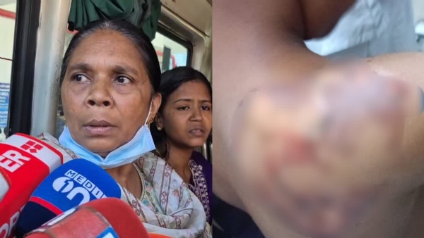 10 year old boy suffers burns