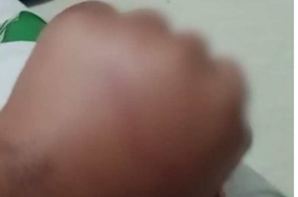 കൊടുവള്ളിയിൽ 12കാരനെ ക്രൂരമായി പീഡിപ്പിച്ച സംഭവം: കേസ് ഒതുക്കിത്തീർക്കാൻ പണവും പാരിതോഷികവും വാഗ്ദാനം ചെയ്ത് പ്രതിഭാഗം; പ്രതികൾ സംസ്ഥാനം വിട്ടതായി സൂചന